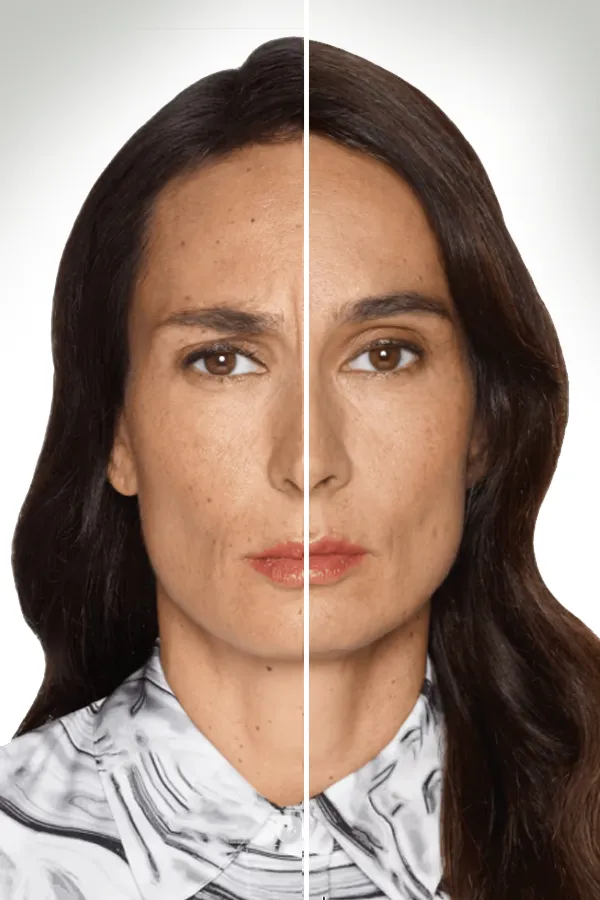 Daxxify-Frown-Line-Therapy-Treatment Before and After photo of Daxxify treatment. Get Daxxify treatment for frown lines from Jennifer Jose-Cappola, MD in Stamford.