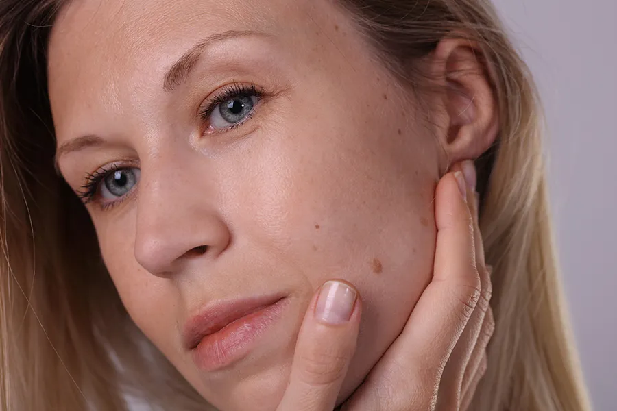 Skin-Tag-Removal-Clinic A beautiful blonde woman with skin tags and benign moles on her face. Get skin tag removal from Jennifer Jose-Cappola, MD in Stamford.