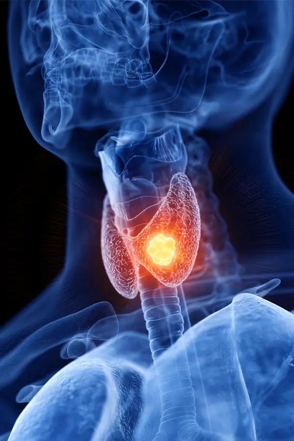 Thyroid-Imbalance-Treatment A 3D illustration of an x-ray of a human neck, highlighting the thyroid. Get help with thyroid imbalance from Jennifer Jose-Cappola, MD in Stamford.